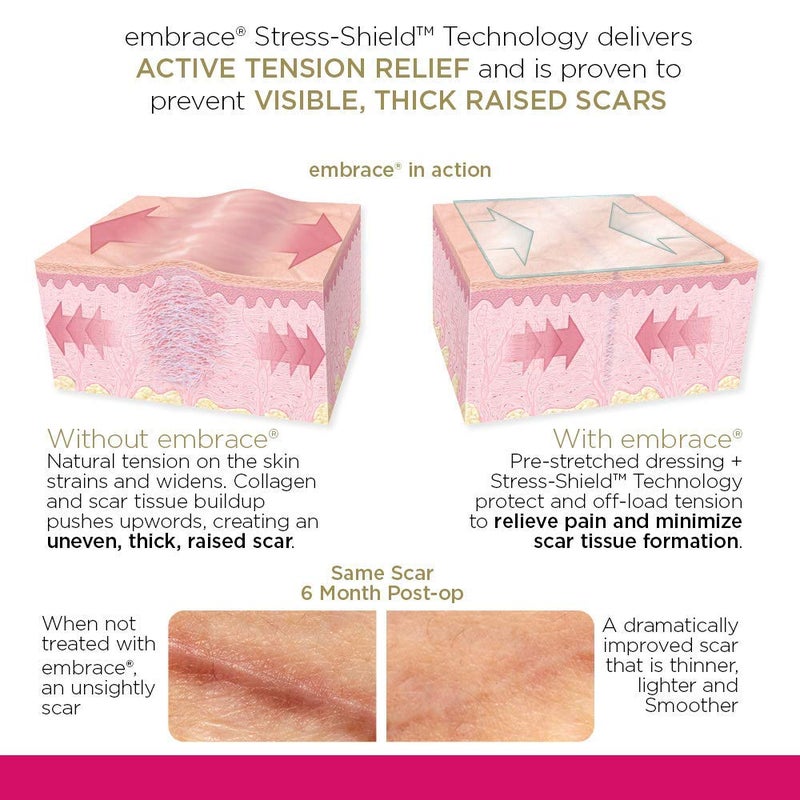 Embrace Active Scar Defense for New Scars, FDA-Cleared Silicone Scar Sheets, 2.4 Inch, Medium, 60 Day Supply (Recommended Treatment) - Image 3