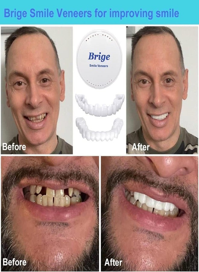 Snap On Smile Veneers, Temporary Cosmetic Teeth, Upper and Lower, White, Reusable with Case - Image 5
