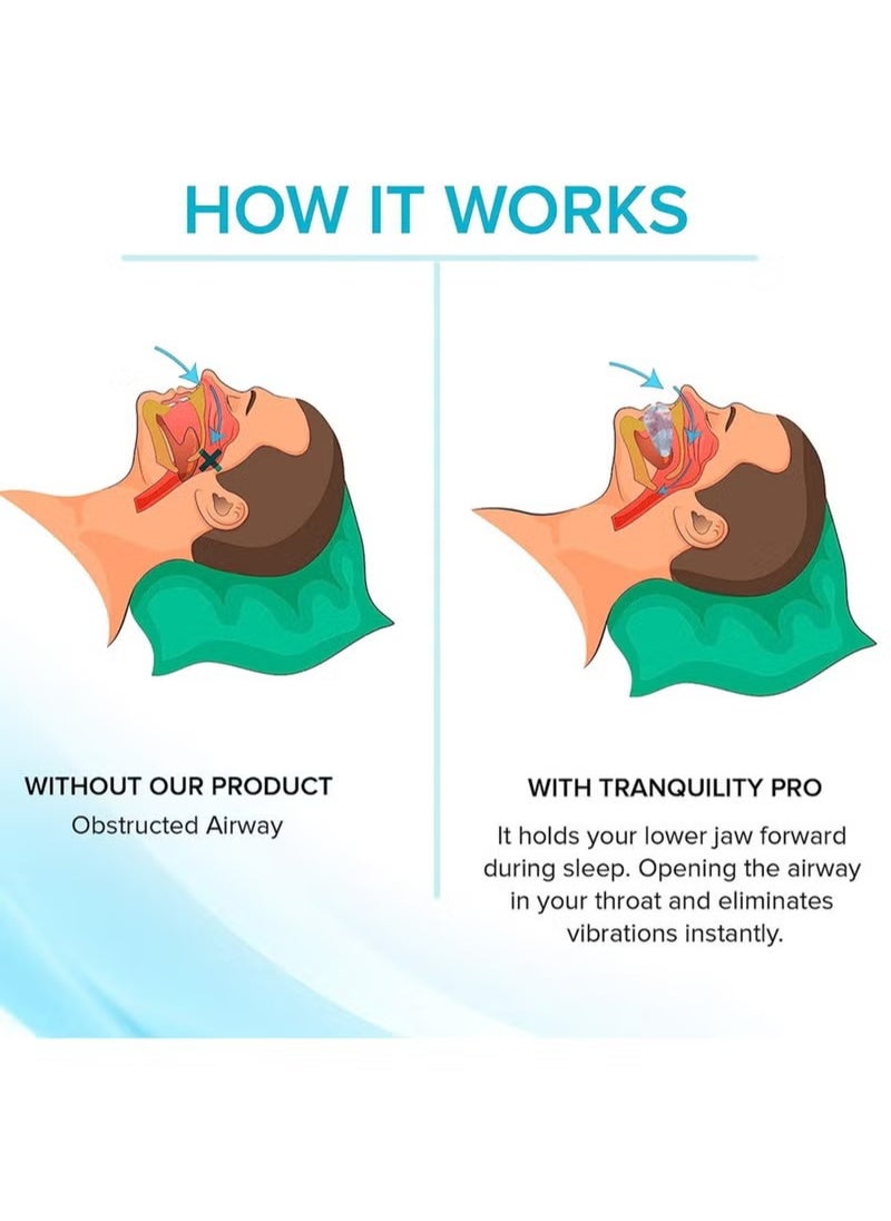 Ocean - Anti-Snoring Mouth Guard Adjustable Mouthpiece Night Time Teeth Mouthguard Sleeping Bite Guard for Bruxism and Stop Snoring Custom Molding Adjustability, Snoring Reduction Aid for Men and Women - Image 1