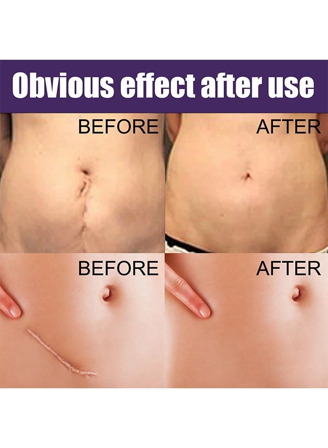 EELHOE Silicone Scar Sheet - Repair Patch,Improve Heal and Reduce Scars, Effective Treatment for Old and New Scars, FadePpregnancy Caesarean Section Scar Hyperplasia Sscar Silicone Repair Patch 8Pcs - Image 3