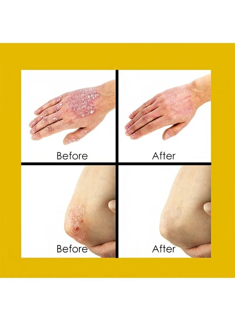 Sumifun Psoriasis Cream，Natural Chinese Herbal Eczema Psoriasis Creams，Treatment Psoriasis Eczema Cream ，Antibacterial Antipruritic Dermatitis Herbal Ointment，Anti-itch Medical Plaster - Image 3