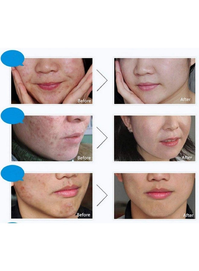 بيو أكوا 4In1 علاج حب الشباب وإزالة الندوب والبقع والبثور وكريم الزيت وأقنعة الوجه وعلامات العيب وزيت الترطيب 100 جرام + 30 جرام + 30 مللي + 4 قطعة X30G - Image 2