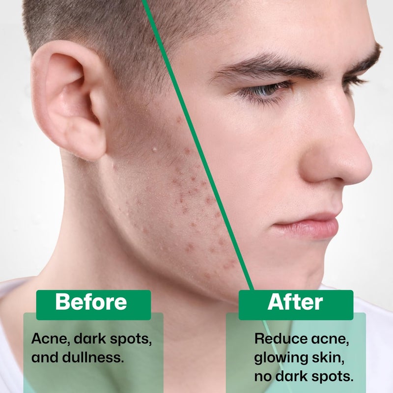 KAZIMA 2 Salicylic Acid Face Serum for Acne Blackheads  Open Pores  Reduces Excess Oil  Exfoliates Skin  Salicylic Acid Serum for Acneprone  Oily Skin  For Women  Men  30 ml - Image 5