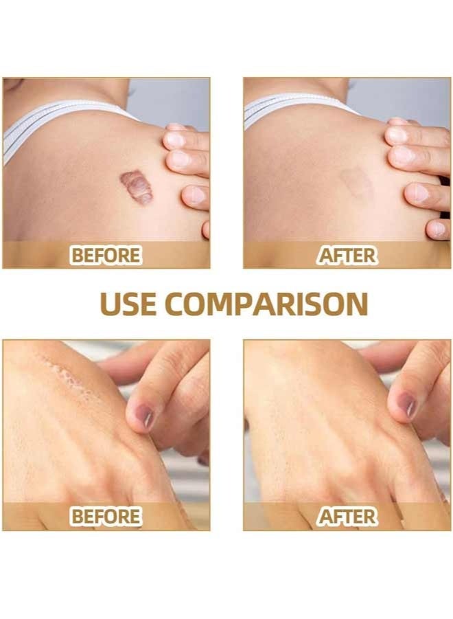 Jaysuing 120PCS  Invisible Skin Concealer Patches, Waterproof Tattoo Scar Cover Up Stickers, Breathable Durable Body Makeup For Bruises Stretch Marks Dark Spots Vitiligo - Image 3