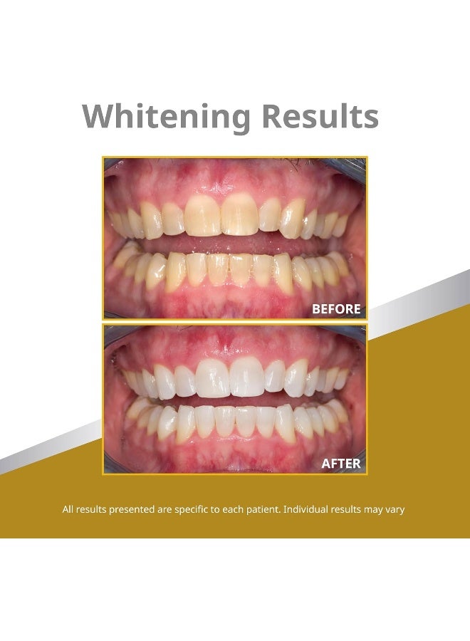 Opalescence Quick RF 45% Teeth Whitening Gel Mint Flavor - Image 4