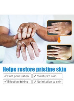SOL LORA Vitiligo Ointment, Reduce White Spots and Improve Skin Pigmentation, Spotted Sweat Stained Vitiligo Skin Cleansing Ointment - 20G  - Image 4