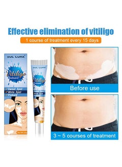 SOL LORA Vitiligo Ointment, Reduce White Spots and Improve Skin Pigmentation, Spotted Sweat Stained Vitiligo Skin Cleansing Ointment - 20G  - Image 5