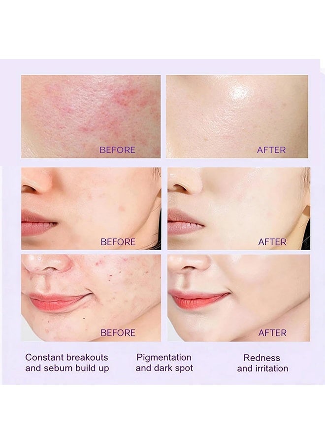 West&Month 15% Azelaic Acid, Niacinamide & Vitamin C,Reduce Face Acne and Repair Skin Discoloration,Hydrating Facial Cream for Acne-Prone & Blemish-Prone Skin, Redness Calming Azelaic Acid Gel for Smooth Skin Texture,20g - Image 5