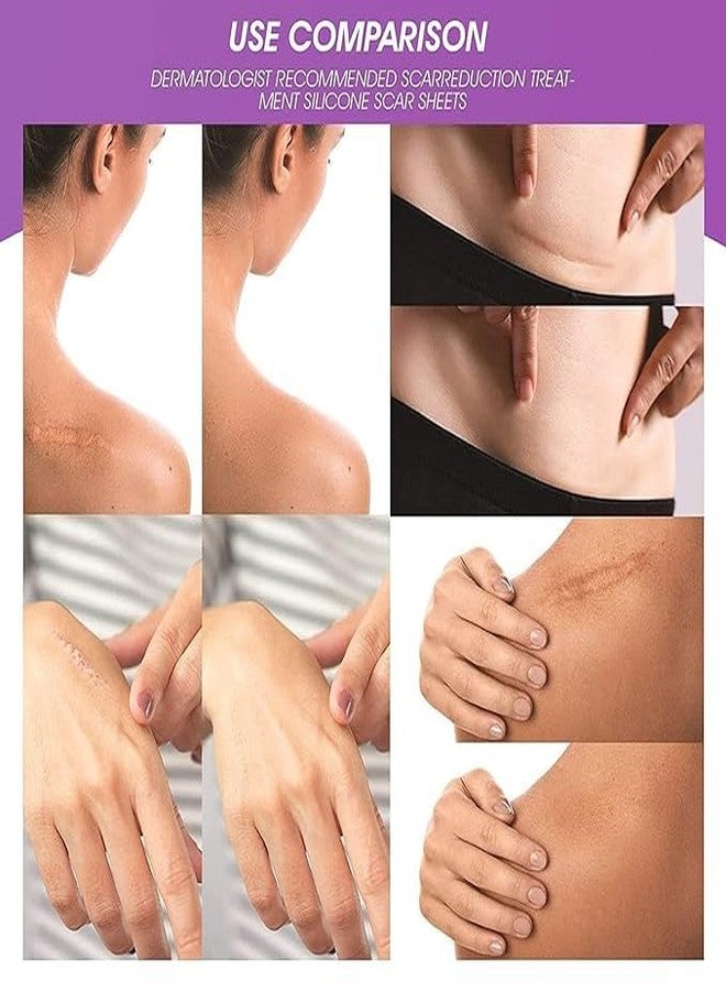 ميسلو شريط سيليكون طبي لعلاج الندبات من ميسلو، 4 قطع، بتقنية متطورة لعلاج الندبات. مصنوع من سيليكون طبي عالي الجودة، مضاد للحساسية، بنتائج مثبتة سريريًا. قابل لإعادة الاستخدام. - Image 3