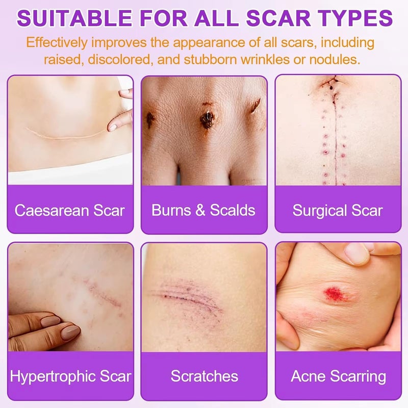 Silicone Scar Sheets Silicone Scar Tape for Surgical Scars  60 x 16 Roll  15M Medical Grade Reusable Effective Scar Removal for Keloid CSection Tummy Tuck and Acne - Image 2