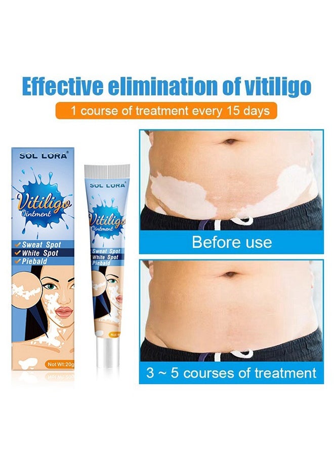 SOL LORA - Vitiligo Treatment Ointment 20g, Vitiligo Care Cream for Skin Vitiligo, Psoriasis, Leukoplakia, Reduces White Spots, Improve Skin Pigmentation Regulating - Image 1