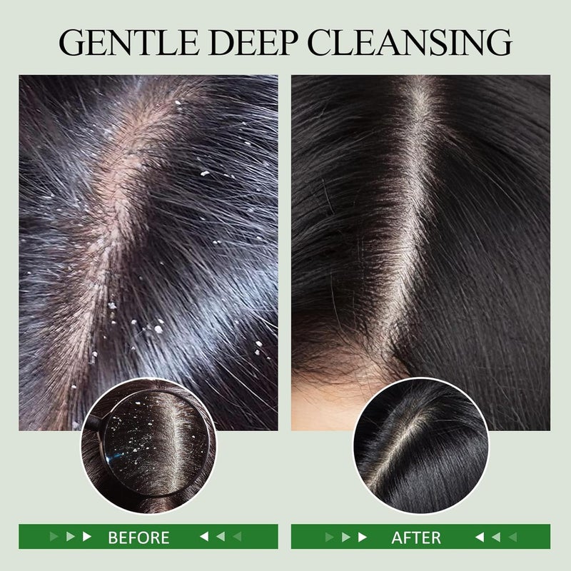 SHVYOG Scalp Scrub, Rosemary Scalp Exfoliator, Scalp Exfoliator Scrub for Build Up, Oily Hair, Hair Treatment Nourishing Detox Hair Care with Scalp Massager - Image 4