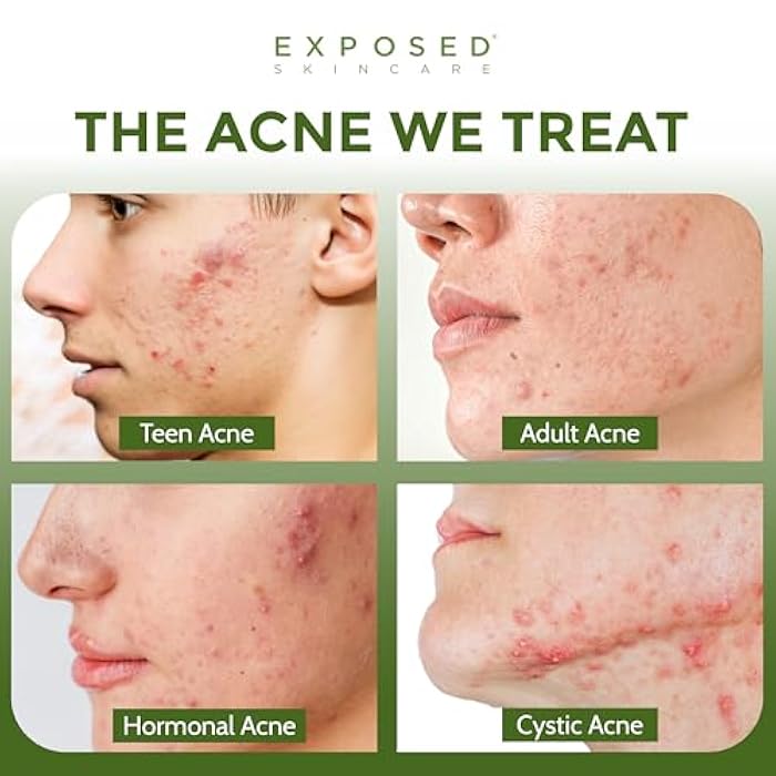 Exposed Skin Care, Acne Treatment Kit with 2.5% Salicylic Acid and 3.5% Benzoyl Peroxide to Clear Up Teen, Adult, Hormonal and Cystic Acne – Natural, Non-toxic and Cruelty Free - Image 2