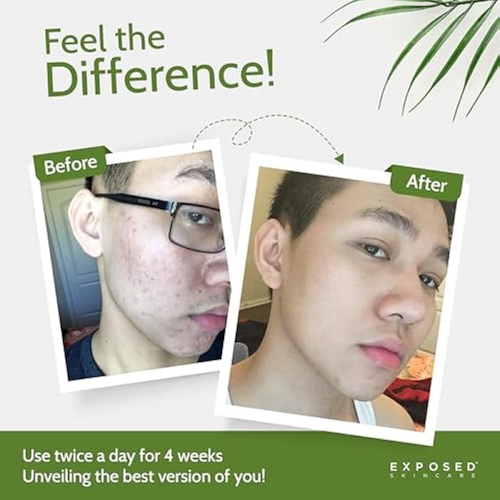 Exposed Skin Care, Acne Treatment Kit with 2.5% Salicylic Acid and 3.5% Benzoyl Peroxide to Clear Up Teen, Adult, Hormonal and Cystic Acne – Natural, Non-toxic and Cruelty Free - Image 4