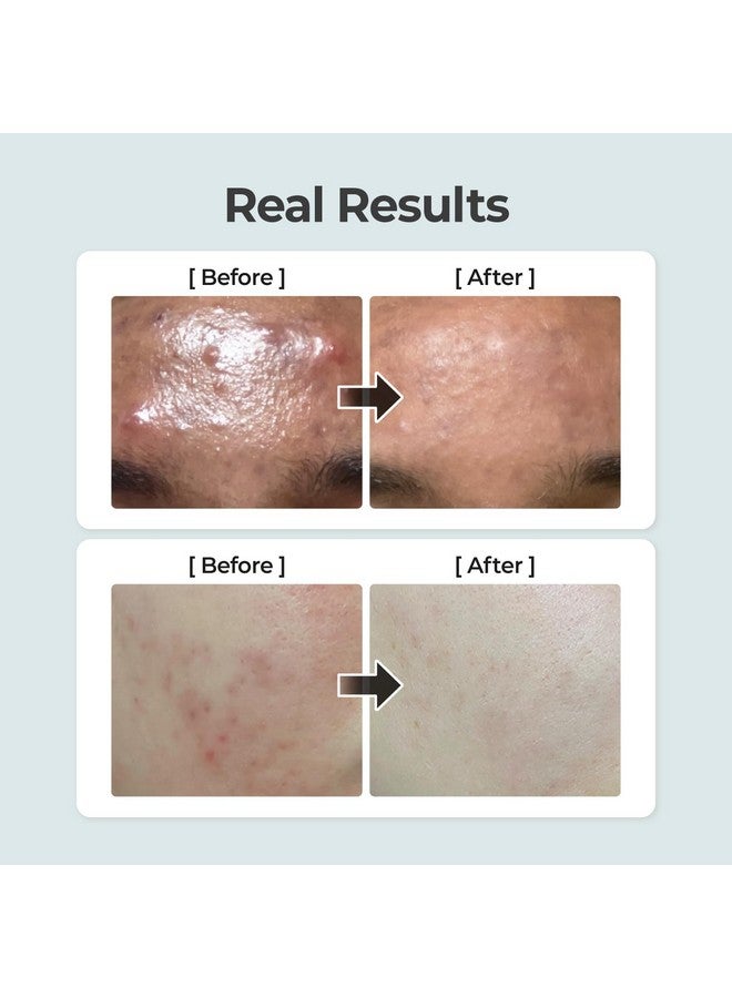 numbuzin No.1 Pure-Full Calming Herb Toner | Breakouts, Redness, Excess Oil Control, Blackhead Removal | Centella Asiatica, Heartleaf, Licorice Root | Acne-Prone, Sensitive Skin | 10.14 fl. oz
