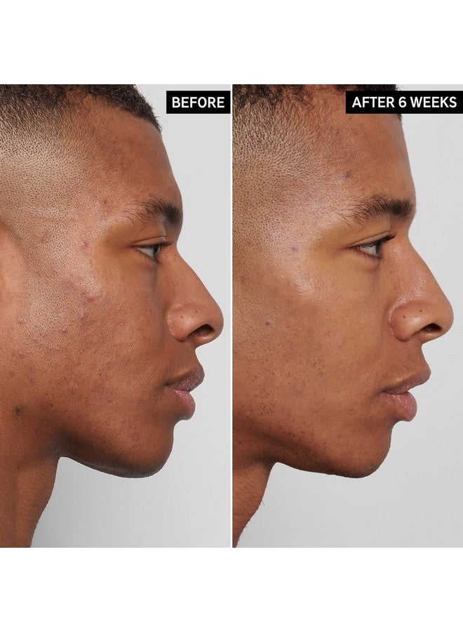 معالجة حمض المندليك 0.5 أونصة سائلة - Image 2