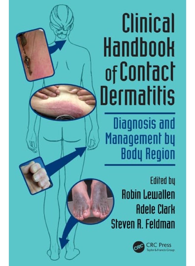 Clinical Handbook of Contact Dermatitis: Diagnosis and Management by Body Region 