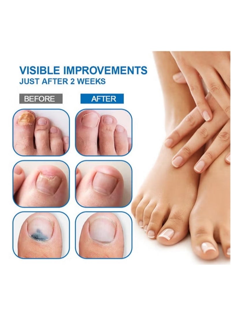 Sumifun Nail Fungus Treatment Cream, Bad Nail Care Ointment, Nail Fungus Treatment, Nail Growth and Repair, Nail Treatment Repair Cream 20g - Image 3