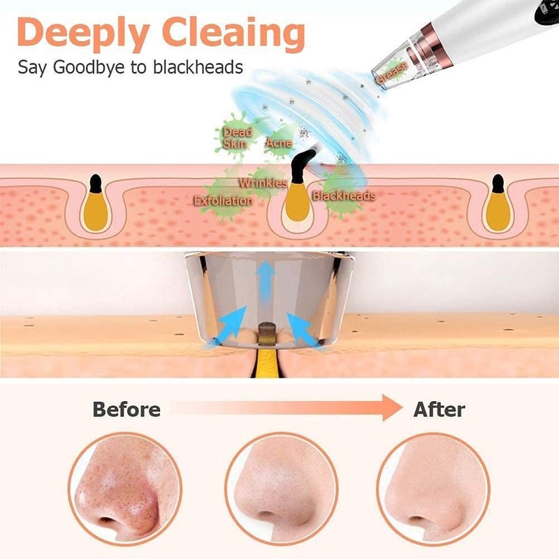 SweetpeaFx 6 in 1 Multifunction Blackhead Remover Tools Electric Derma suction Machine Acne Pimple Pore Cleaner Vacuum tool Facial Cleanser Device for Nose Skin Care White - Image 3