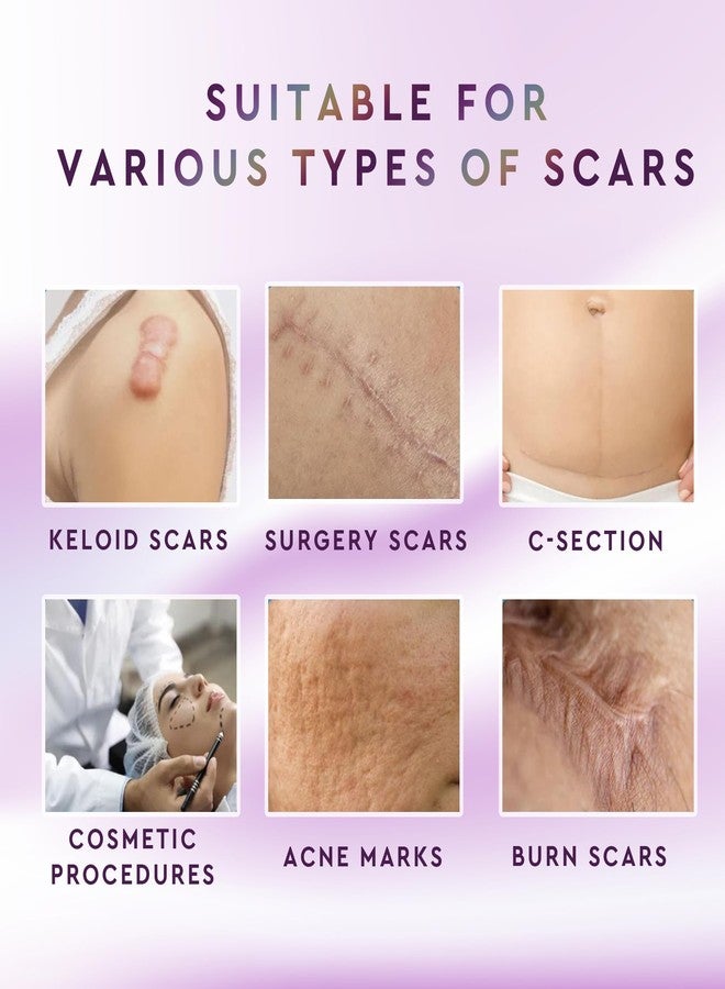 suquato Advanced Silicone Scar Removal Cream for Keloid Bump Removal, Must have Gel for C Section, Hysterectomy, Mastectomy, Tummy Tuck, Surgical Scars, Acne Marks, Stretch Marks, Keloid Scars treatment - Image 3