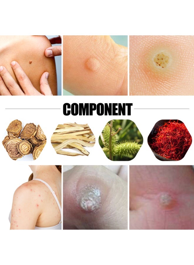 ساوث مون ضمادات لإزالة مسامير القدم، ضمادات لإزالة الثآليل، علاج لتخفيف آلام مسامير القدم والعناية بالقدم، لصقات تنظيف مضادة للبكتيريا ومضادة للالتهاب - Image 4