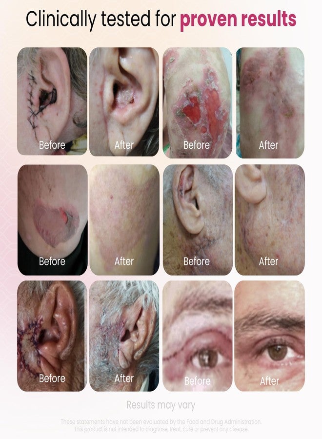 GlocalCare مكمل غذائي GlocalCare CICA مثبت سريريًا لالتئام الجروح - يساعد في دعم التئام الندبات والتعافي - يساعد في إصلاح الجلد والأنسجة بعد العمليات الجراحية والجروح وعلاج الندبات والكدمات (20 كبسولة) - Image 4