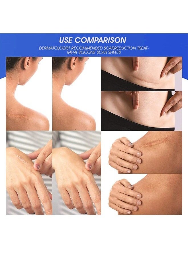 Silicone Scar Sheets—Scar Remover Patch, Silicone Scar Sheets For Scars Stretch Mark Treatment Waterproof, 4 Reusable Sheets, Size 5.9" x 1.6"