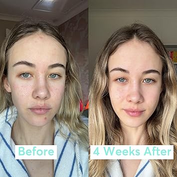 Super Facialist PoreFect Daily Moisturiser Hydrate Control Oil for Acne Treatment Blackhead Remover with 3 Niacinamide Tea Tree Oil Prebiotics Vegan Friendly 75ml - Image 4