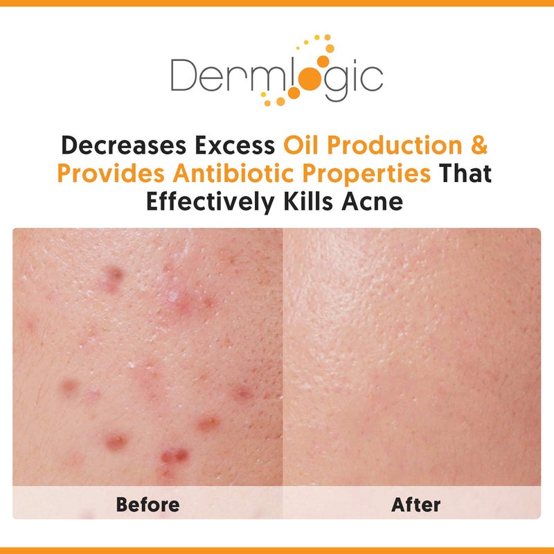 Dermlogic Acne Face & Body Cream- Maximum Strength Treatment for Cystic, Blackhead & Whitehead Pimples. Prevents Future Breakouts. - Image 4