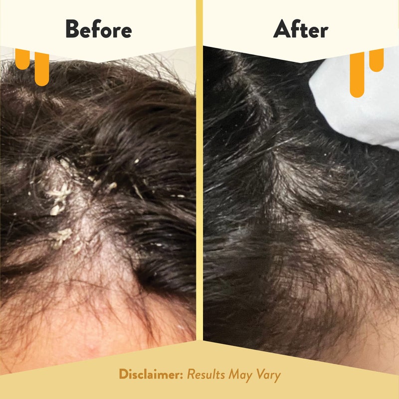 ECZEMA HONEY Soothing Scalp Oil - Natural Honey Hair Oil & Scalp Care - Daily Itchy Scalp Relief Serum - Dry Scalp Treatment Helps With Psoriasis, Seborrheic Dermatitis, Dandruff & More (1 Oz) - Image 4