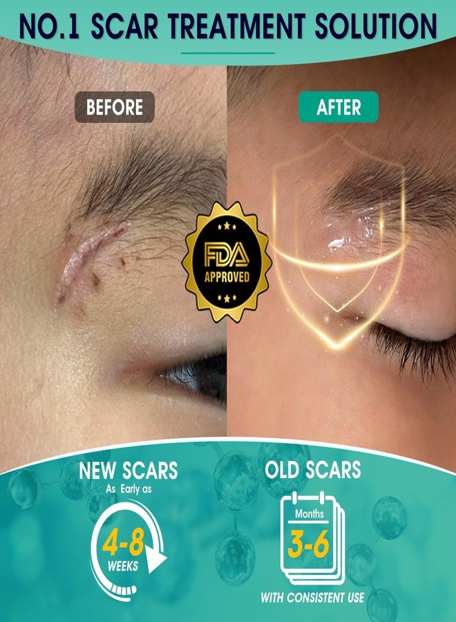 ScarMD جل سكار إم دي السيليكوني لعلاج الندبات - تصميم تدليك لشفاء أسرع | كريم مثبت سريريًا لعلاج الندبات الجراحية، وتسطيح الندبات الجدرية وندبات حب الشباب | كريم سيليكوني نقي 100% (0.21 أونصة) - Image 4