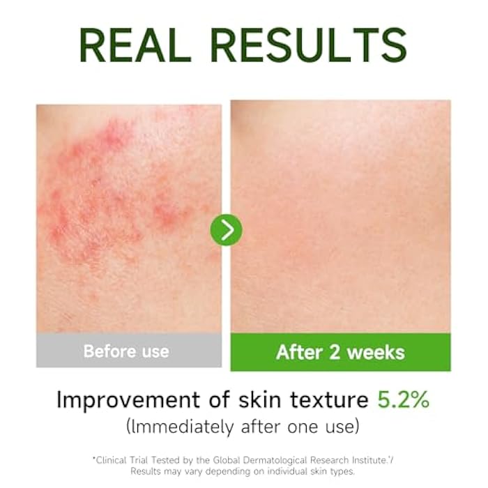 Gaayou Centella Asiatica Serum Centella Tea Tree Ampoule Facial Serum Korean Centella Serum for Acne-Prone Oil Skin Soothing, Calming, Reduce Redness 105ml - Image 3