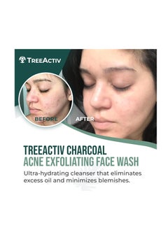 TreeActiv Acne Face Wash Sulfur & Charcoal 3.4 fl oz 100ml  - Image 3