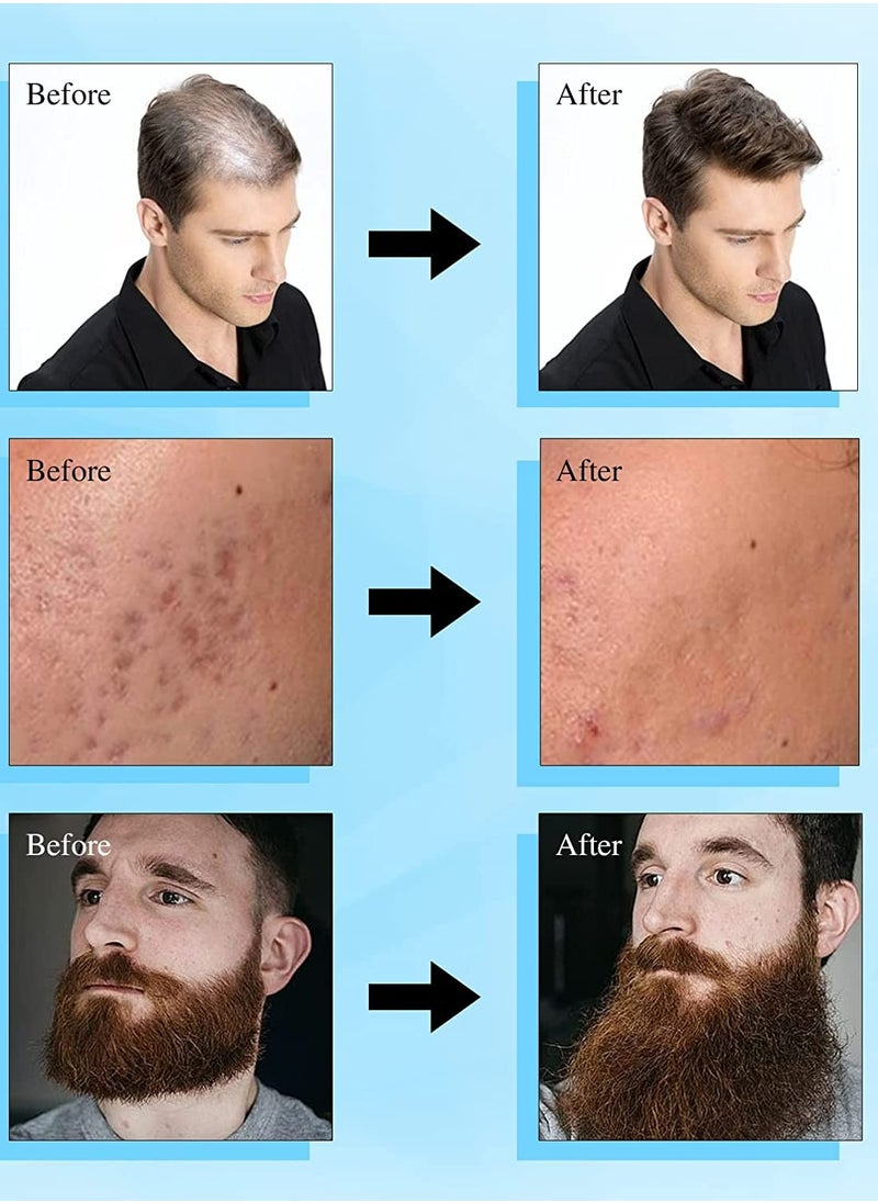 Derma Stamp Dermastamp 140 Tips 1 mm Titanium Microneedle Stamper Auto Derma Pen Dermapen Professional Microneedling Real Individual Micro Needles Dermabrasion For Face Body Hair Beard Growth