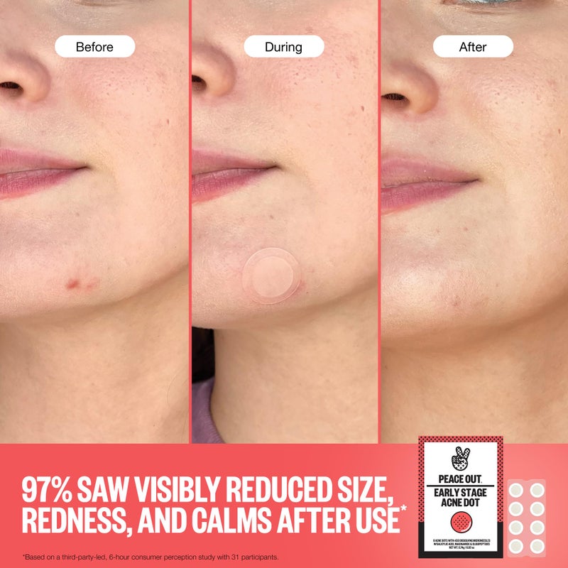 PEACE OUT Early Stage Acne Dots Helps Target Blemishes Below the Surface, Hydrocolloid Pimple Patches Minimize Bumps Before They Appear with Dissolving Microneedles, Salicylic Acid, 8 Count - Image 4