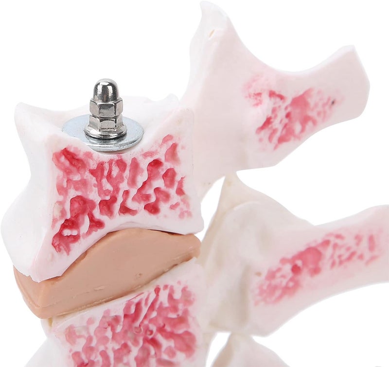 klarako Professional Osteoporosis Model, Human Anatomical Spine Model for Medical Educational Training Teaching Demonstration - Image 5