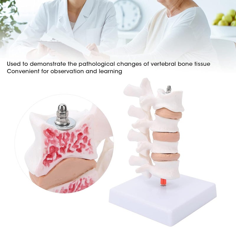 klarako Professional Osteoporosis Model, Human Anatomical Spine Model for Medical Educational Training Teaching Demonstration - Image 2