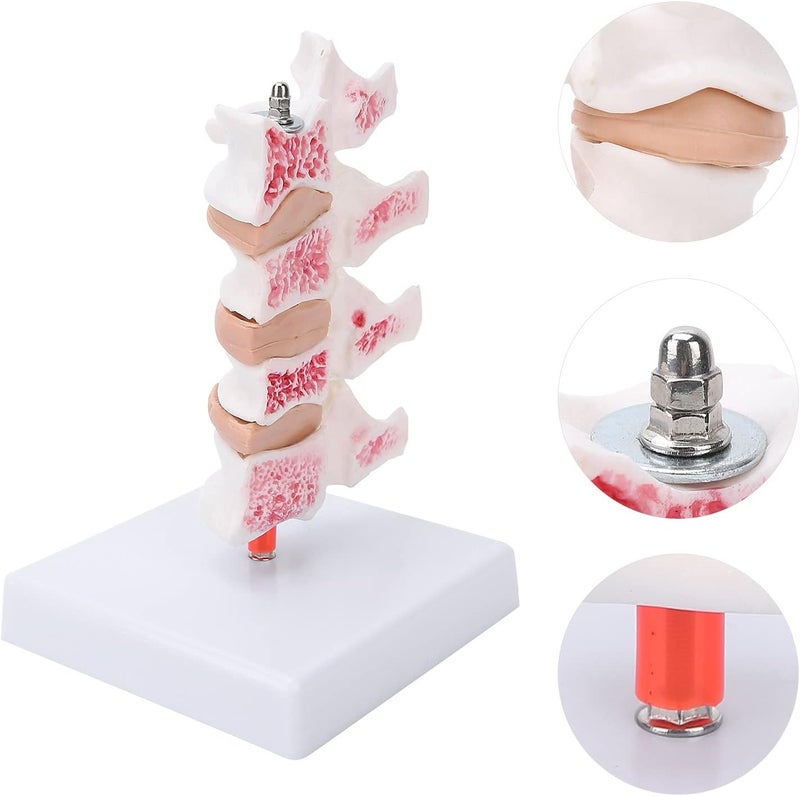 klarako Professional Osteoporosis Model, Human Anatomical Spine Model for Medical Educational Training Teaching Demonstration - Image 4