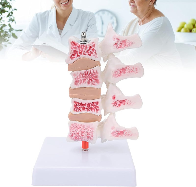 klarako Professional Osteoporosis Model, Human Anatomical Spine Model for Medical Educational Training Teaching Demonstration - Image 1
