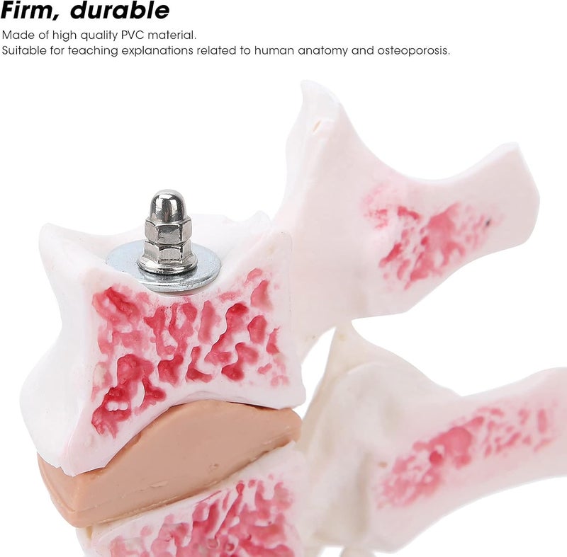 klarako Professional Osteoporosis Model, Human Anatomical Spine Model for Medical Educational Training Teaching Demonstration - Image 3