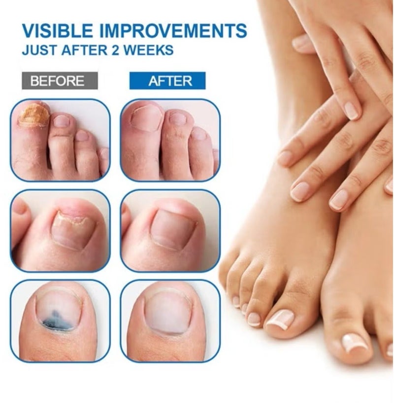Sumifun Nail Fungus Treatment Cream, Soothing Nail Discomfort,Broken Nail Repair,Easier Foot Care,Bad Nail Care Ointment, Nail Fungus Treatment, Nail Growth and Repair, Nail Treatment Repair Cream 20g - Image 3