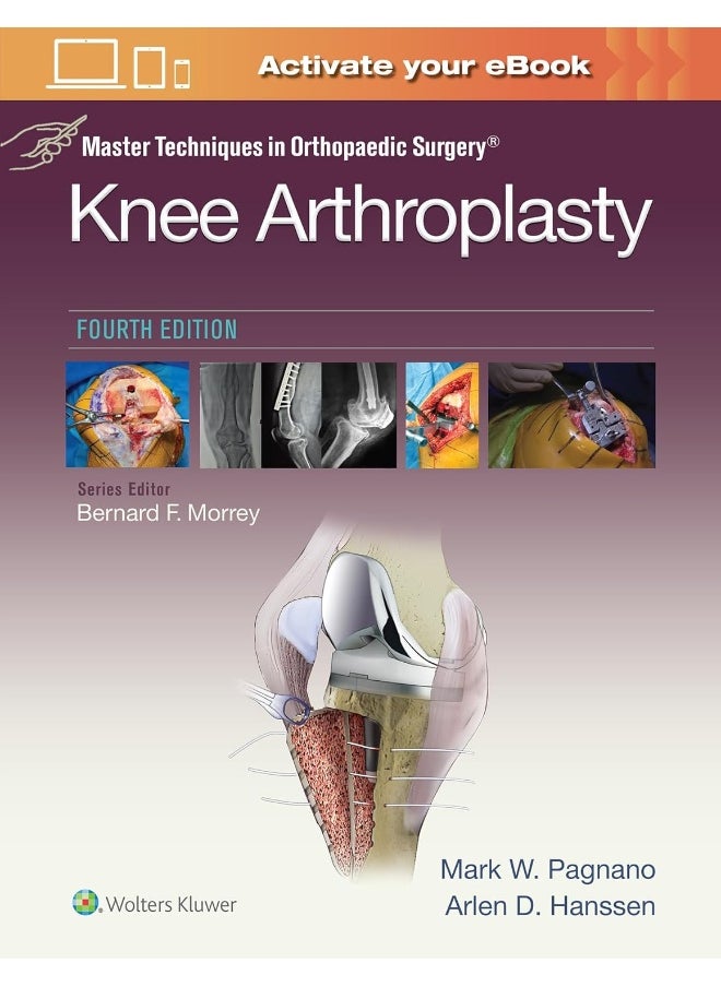 Master Techniques in Orthopedic Surgery: Knee Arth 