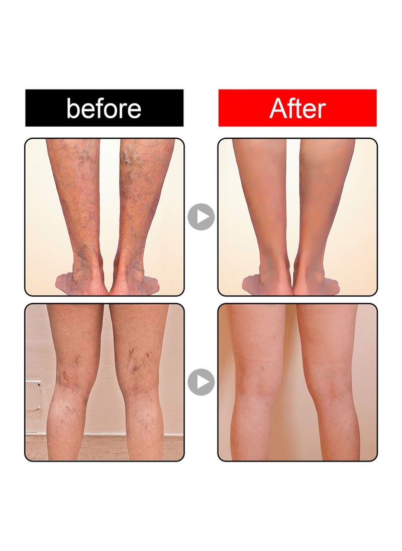 Jaysuing - Varicose Veins Patches for Legs to Improve Blood Circulation Strengthen Capillary Health Relieve Swelling Pain and Fatigue Minimize Varicose Vein and Spider Vein 12 Pcs/Pack - Image 1