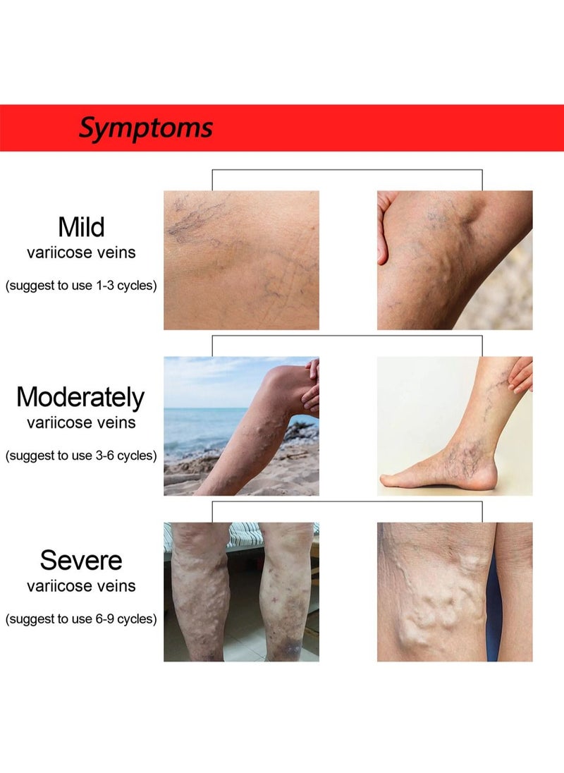 Jaysuing - Varicose Veins Patches for Legs to Improve Blood Circulation Strengthen Capillary Health Relieve Swelling Pain and Fatigue Minimize Varicose Vein and Spider Vein 12 Pcs/Pack - Image 1