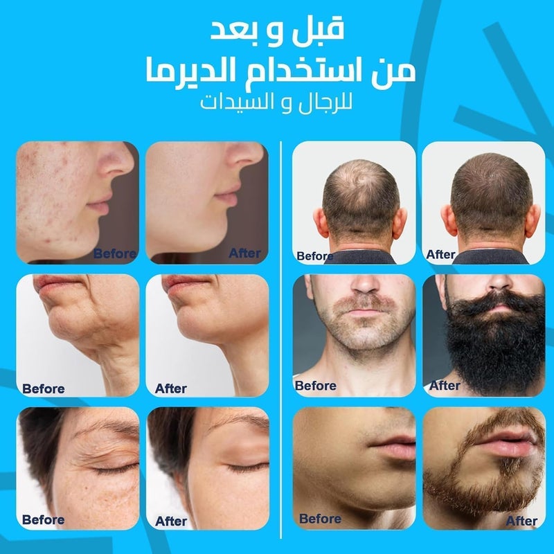 Derma Stamp for Hair Growth & Facial Spa | Titanium Coated Adjustable Needles 0.25mm to 3mm | 140 Microneedling Stamp for Skin Repair, Face, Hair & Beard Growth | Reduces Acne Scars | Safe & - Image 4