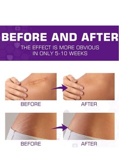 HBESTY Silicone Scar Gel, Scar Cream，Scar Gel，Acne Scar Treatment，Deep Acne Scar Removal， Burns Keloids Hypertrophic， Scar Removal Cream， Repair Damaged Skin，Removing Acne Marks,  Scar Repair Cream  - Image 5