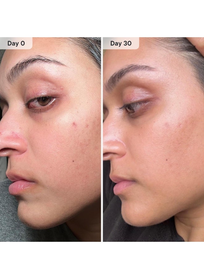 Qure Skincare Micro-Infusion System | At-Home Microneedling Facial | 24K Gold 0.5mm Needles | Hydrating & Anti-Aging Serums | Pore-Minimizing, Collagen-Boosting & Skin Rejuvenating | 3-Month Supply - Image 5