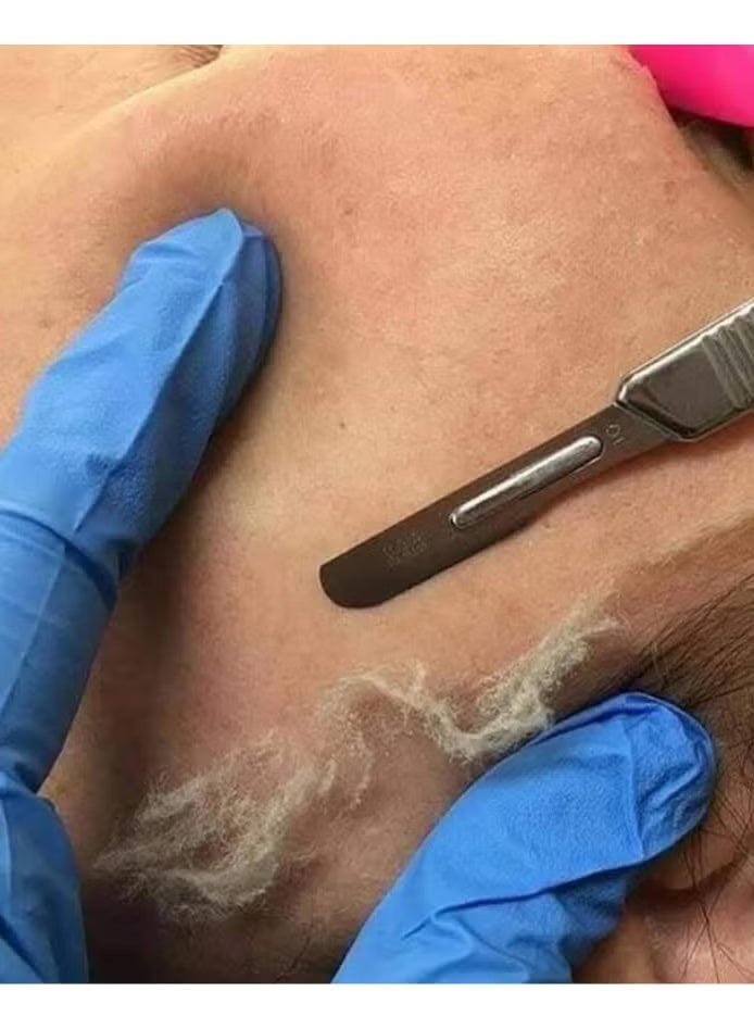 Dermaplaning with 10 blades to remove lint and exfoliate dead skin - Image 4