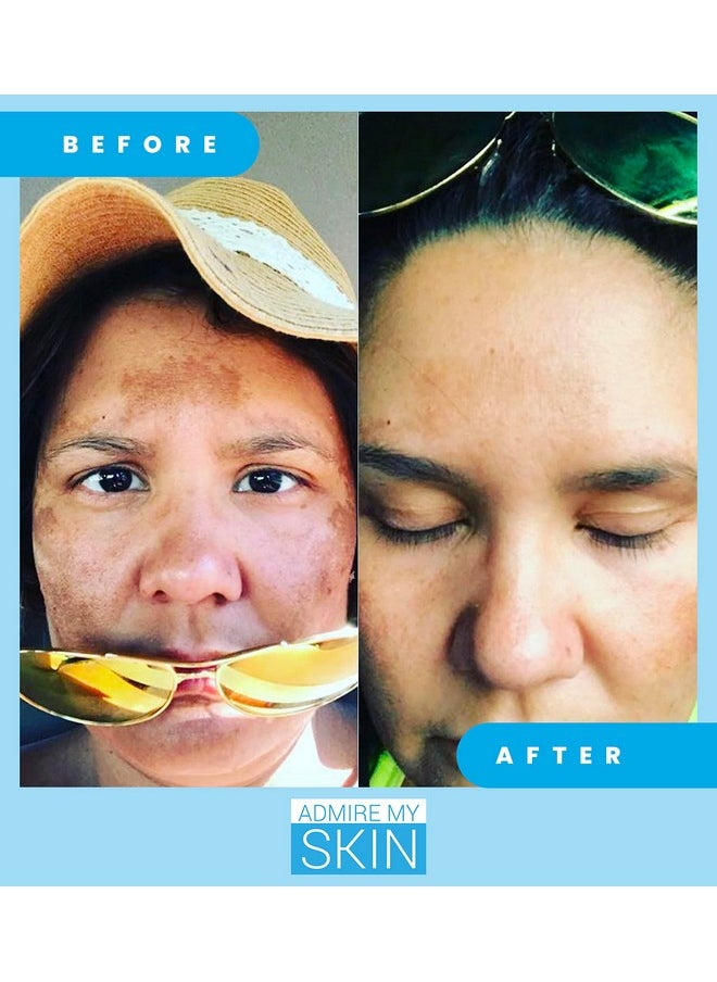 Admire My Skin - Dmire My Skin Dark Spot Corrector Remover For Face Brightening Discoloration Correcting Serum Melasma Treatment Cream With Synovea Kojic Acid Vitamin C Salicylic Acid Lactic Acid Serum - Image 1