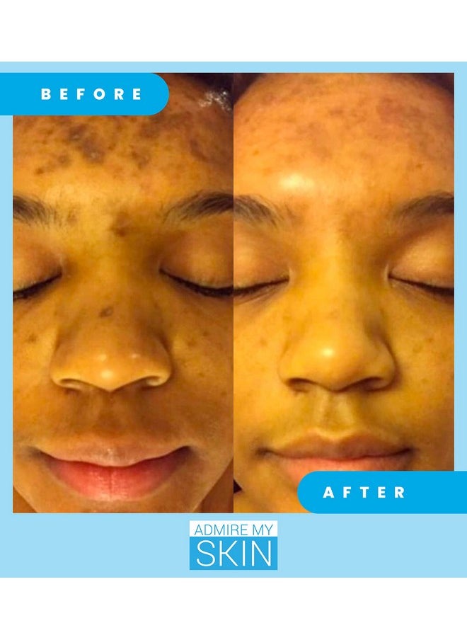 Admire My Skin - Dmire My Skin Dark Spot Corrector Remover For Face Brightening Discoloration Correcting Serum Melasma Treatment Cream With Synovea Kojic Acid Vitamin C Salicylic Acid Lactic Acid Serum - Image 1